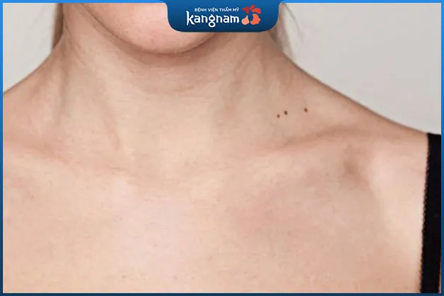 Người sở hữu 3 nốt ruồi ở cổ có số lận đận, hay bị tiểu nhân phá hoại