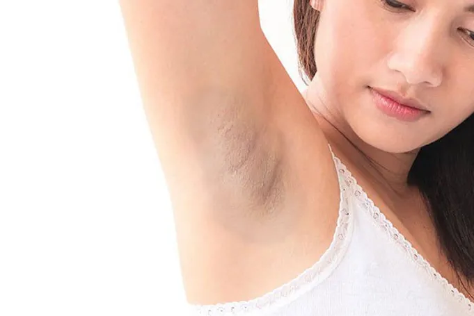 Lỗ chân lông vùng nách bị bít tắc gây thâm sạm