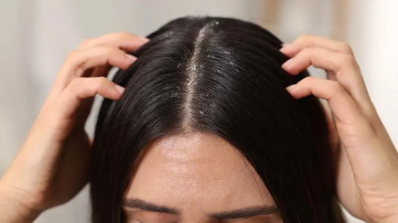 Gội đầu với lá dứa giúp trị gàu hiệu quả, nuôi dưỡng tóc