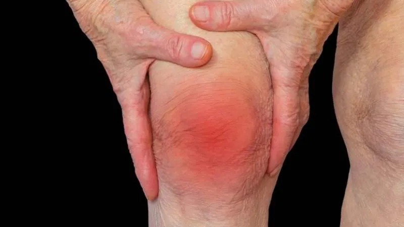 Lá dứa là nguyên liệu dùng trong bài thuốc trị bệnh viêm khớp sưng đau