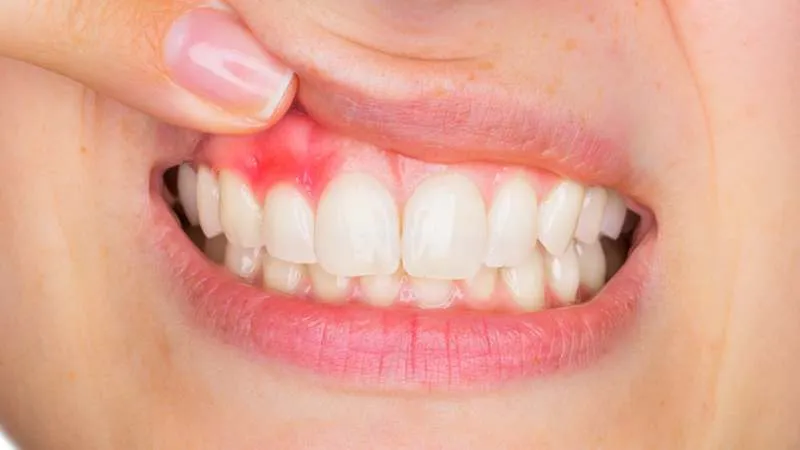 Nhai sống trực tiếp lá dứa giúp trị đau nhức răng, viêm nướu hiệu quả