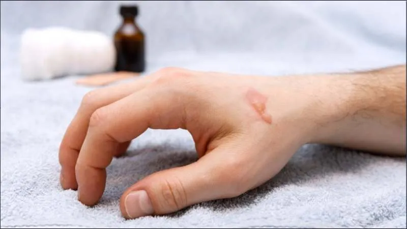 Đắp lá dứa khô nghiền nát ngoài da giúp điều trị bỏng nhẹ, làm dịu da