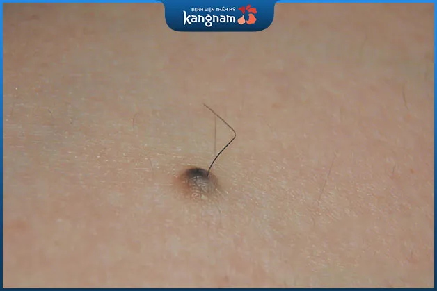 Lông mọc trên nốt ruồi ở cổ ám chỉ đường tình duyên lận đận