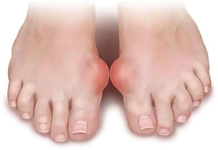 Người bệnh gout cần hạn chế ăn gan gà do hàm lượng purin cao