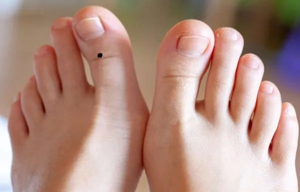 Nốt ruồi may mắn dưới lòng bàn chân nam giới, thể hiện cuộc sống viên mãn