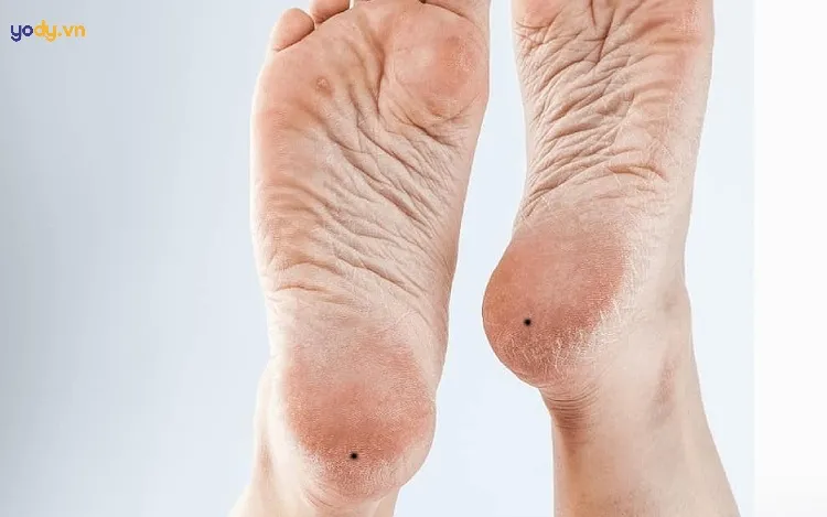 Nốt ruồi ở gót chân trái nữ