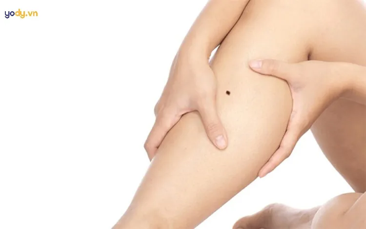 Nốt ruồi ở bắp chân trái