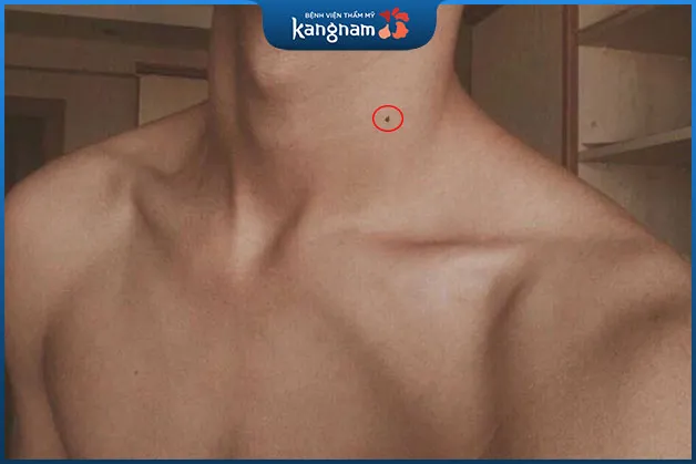 Xem tướng nốt ruồi ở cổ nam giới