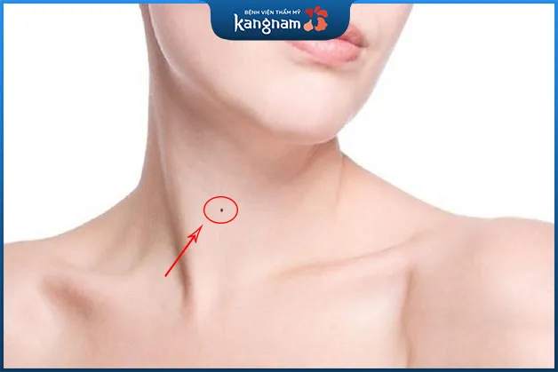 Người có nốt ruồi ở cổ thường được cho là phú quý, giàu sang