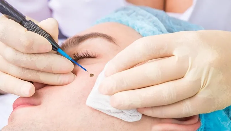 Tham khảo ý kiến của chuyên gia trước khi tẩy nốt ruồi