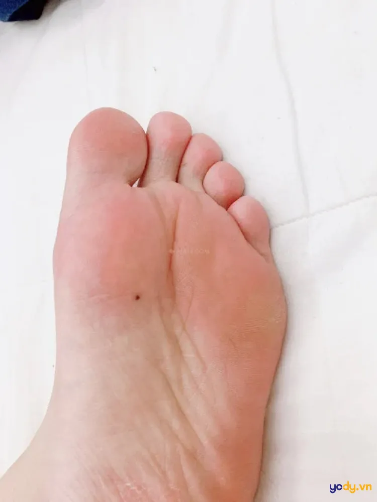 Nốt ruồi ở lòng bàn chân nam