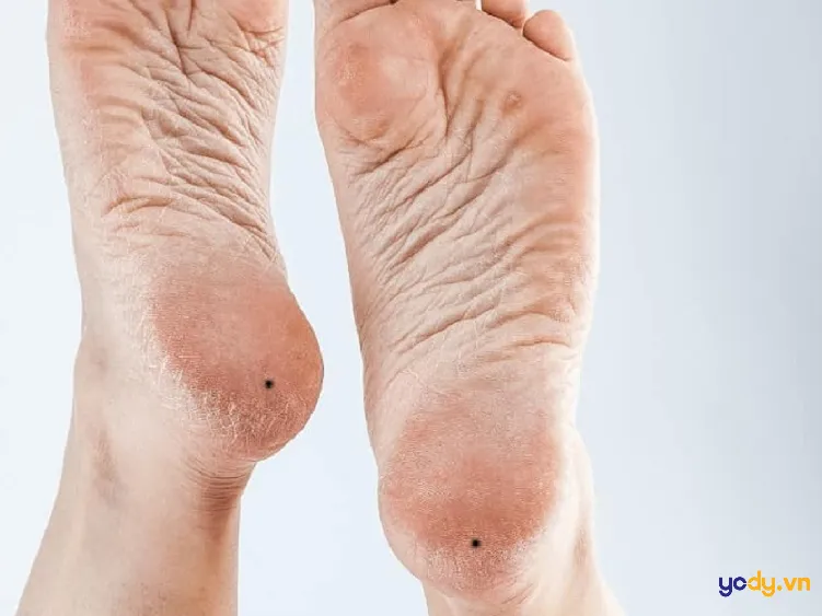Ý nghĩa nốt ruồi ở gót chân