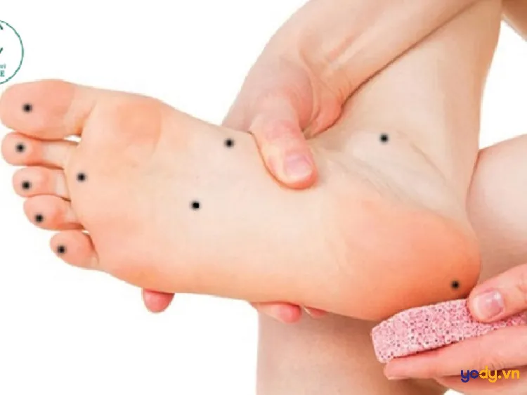 9 nốt ruồi dưới lòng bàn chân