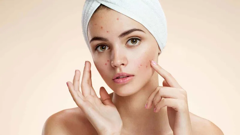 Người đang mắc tình trạng mụn trứng cá không nên ăn bánh trung thu