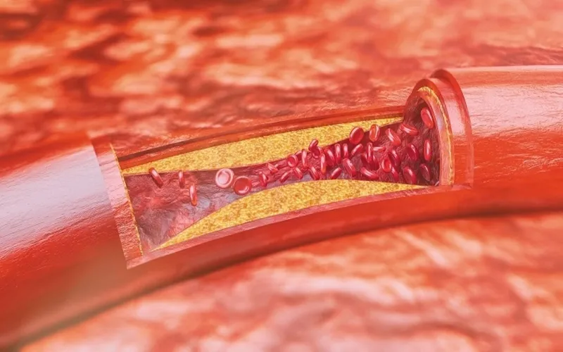 Ăn mì tôm thường xuyên có thể làm tăng lượng cholesterol xấu trong cơ thể