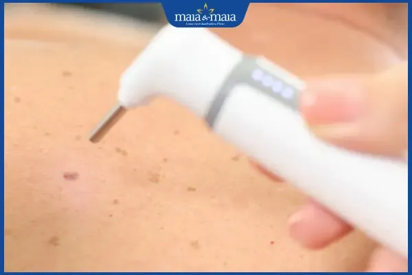 Phương pháp bắn laser để xóa nốt ruồi