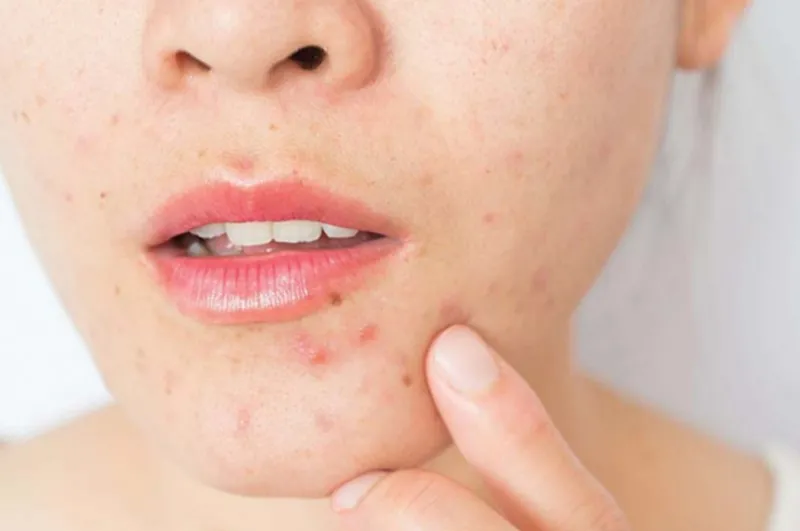 Ăn nhiều bánh Karo có thể gây nổi mụn