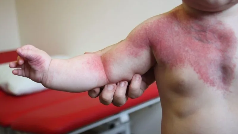 Vết bớt đỏ trên da em bé phát triển nhanh, cảnh báo cần cha mẹ đưa đi khám bác sĩ