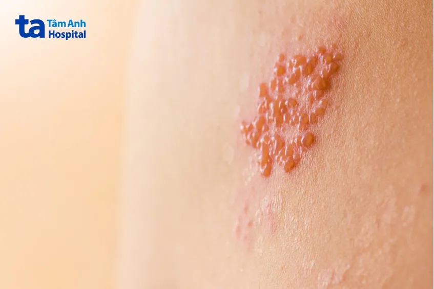 Phát ban và mụn nước điển hình của bệnh zona thần kinh
