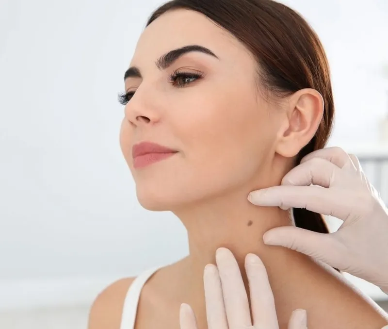 Nốt ruồi trong phong thủy và các phương pháp tẩy