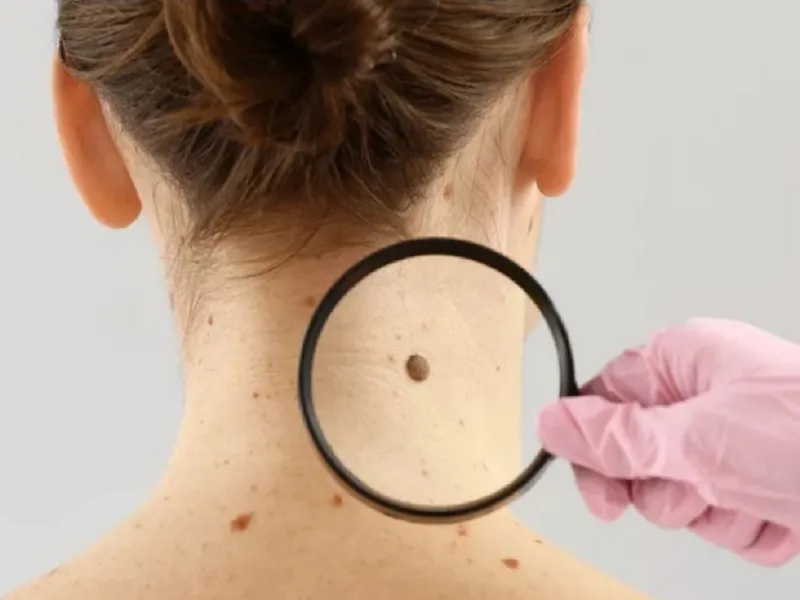 Nốt ruồi là những chấm sắc tố trên da