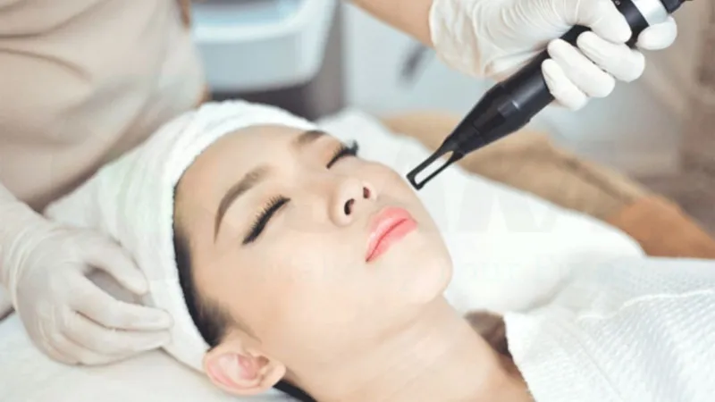 Công nghệ laser - giải pháp xóa nốt ruồi hiệu quả