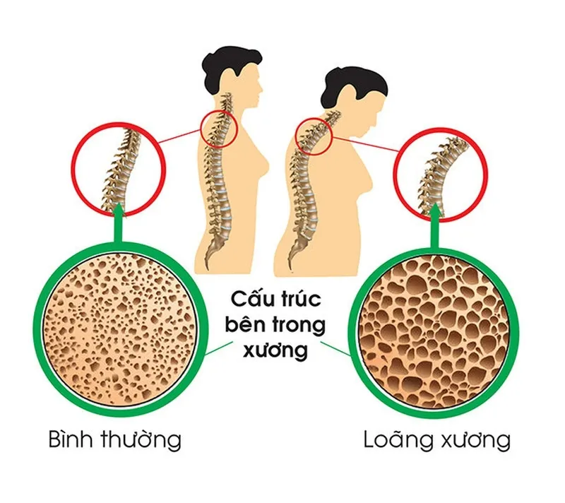 Bổ sung cải ngọt giúp phòng ngừa nguy cơ loãng xương ở người cao tuổi