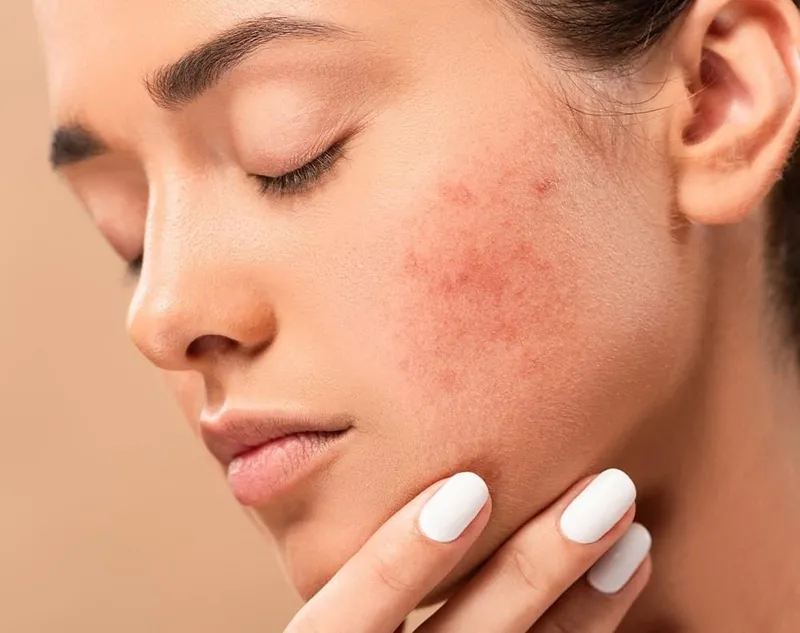 Quá trình và thời gian lành sẹo sau khi tẩy nốt ruồi