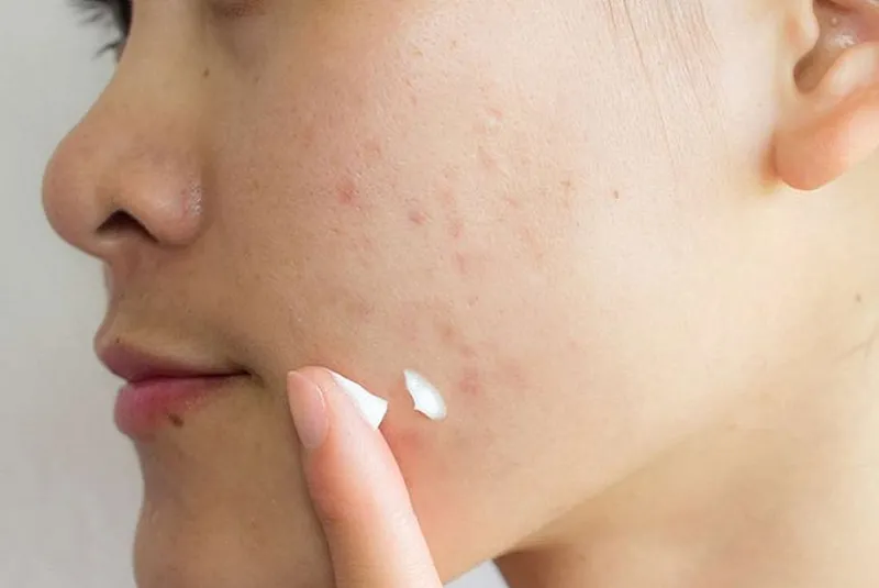 Thời điểm lý tưởng để thoa kem trị sẹo sau khi tẩy nốt ruồi