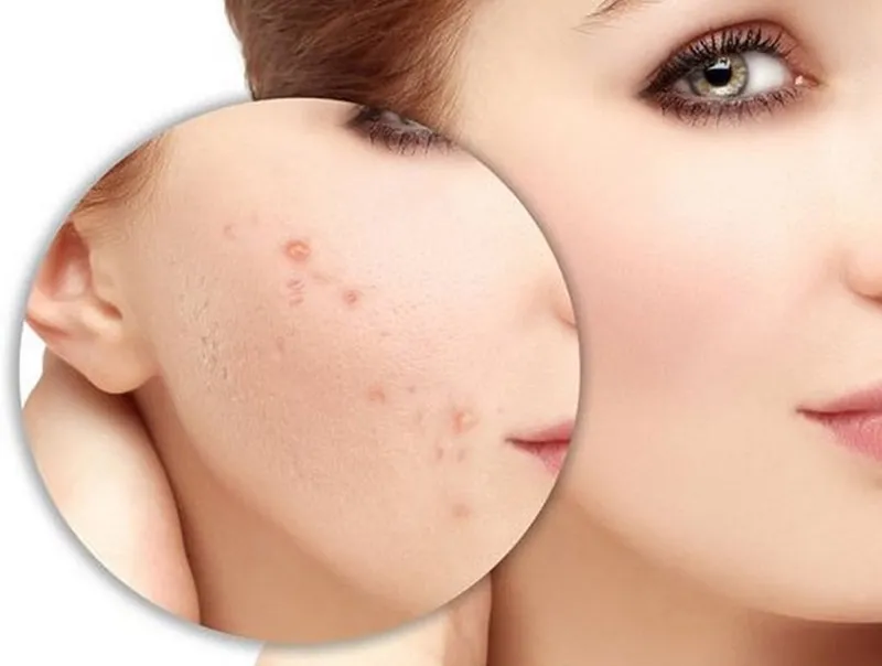 Một người đang thoa kem tái tạo da lên vùng da vừa tẩy nốt ruồi