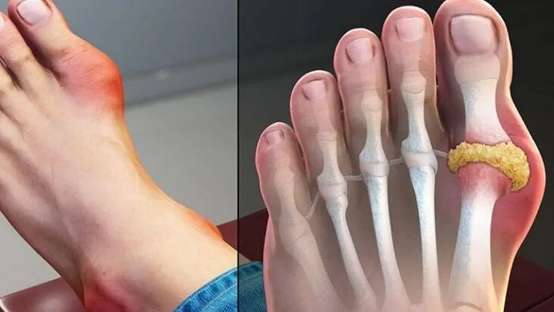 Người bị bệnh gout cần cẩn trọng khi ăn khoai mì để tránh làm nặng thêm tình trạng bệnh