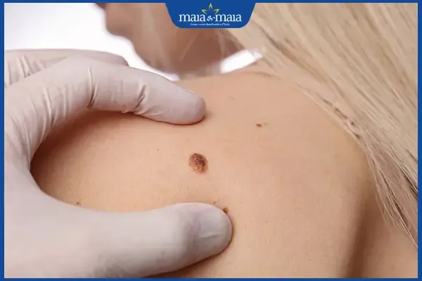 Nốt ruồi mọc ở vai nữ giới được cho là điềm báo của những điều không may mắn