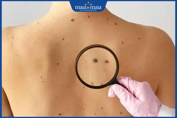 Mốc nốt ruồi sau lưng