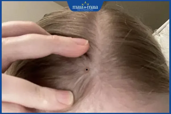 Nốt ruồi ẩn trong mái tóc ở đỉnh đầu mang lại nhiều may mắn