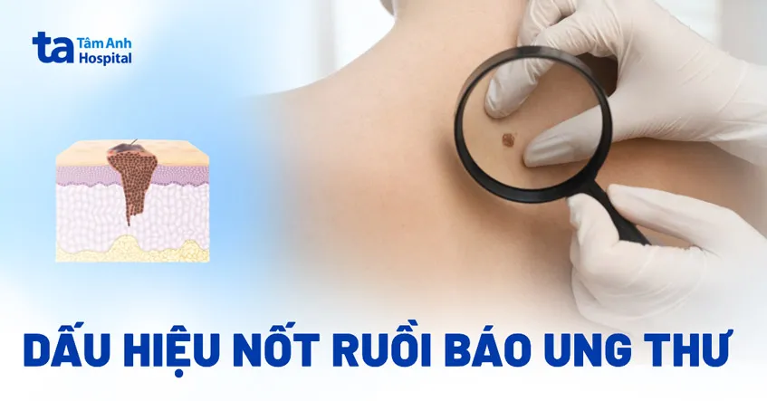 Nốt ruồi có dấu hiệu bất thường