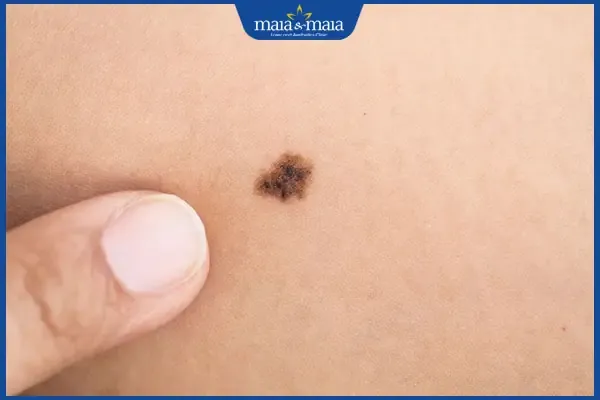 Dấu hiệu nốt ruồi bất thường cần đi khám bác sĩ