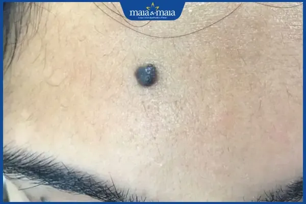 Nốt ruồi ở trán bên phải của nữ giới
