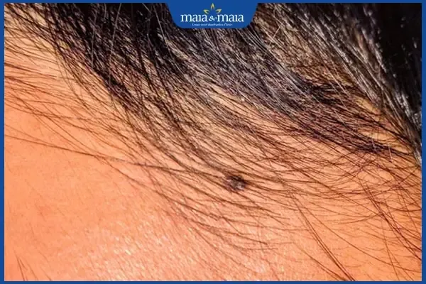 Nốt ruồi tại cung Thiên Di, góc trán