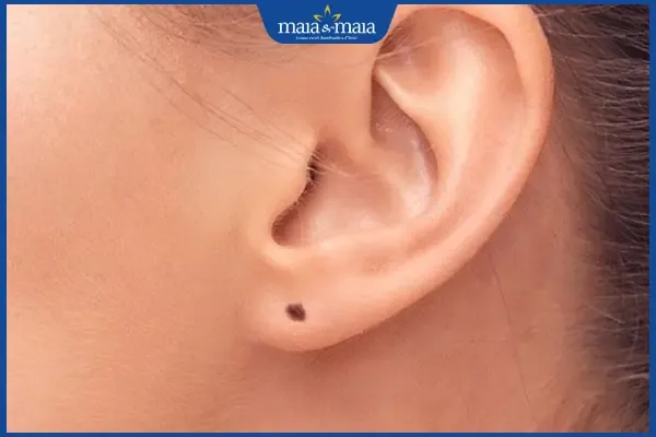 Vị trí nốt ruồi ở dái tai, được xem là biểu tượng của sự thông minh và phúc lộc