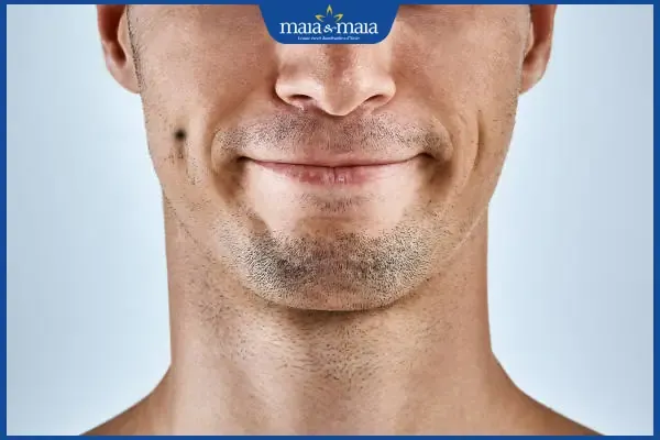 Nốt ruồi má lúm đồng tiền