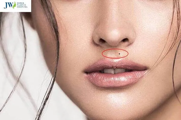 Phân tích nốt ruồi theo màu sắc và vị trí trên nhân trung
