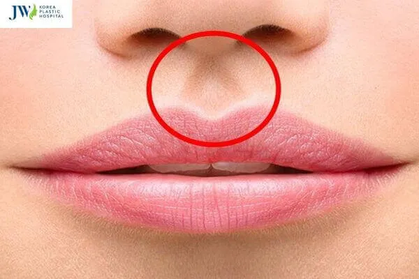 Sơ đồ giải thích các vị trí của nhân trung trên mặt