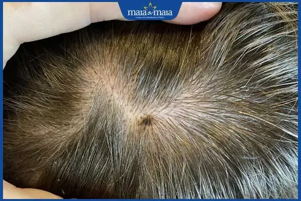 Vị trí nốt ruồi lệch phải trên đỉnh đầu báo hiệu sự linh hoạt và may mắn tình duyên