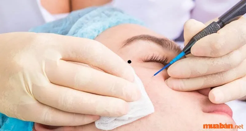 Xóa nốt ruồi ở đuôi mắt phải nữ không quá cần thiết