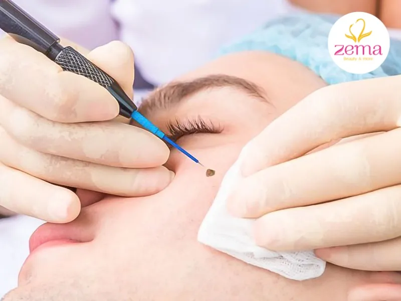 Tẩy nốt ruồi ở mắt có nên hay không?
