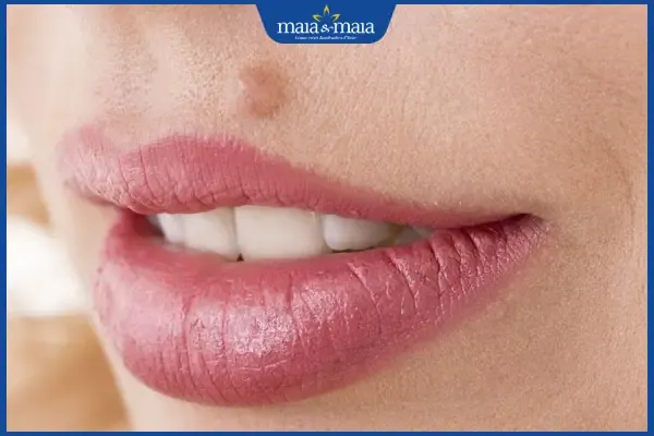 Vị trí nốt ruồi ở mép nhân trung và ý nghĩa