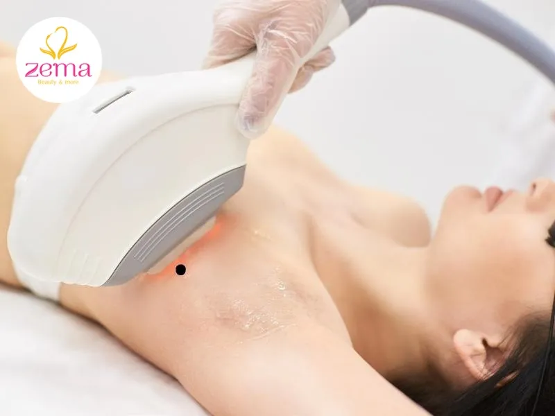 Có nên đi tẩy xóa nốt ruồi ở nách không?