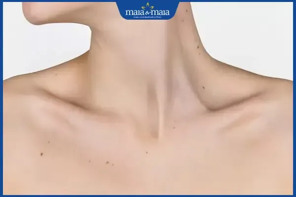 Nốt ruồi quanh xương quai xanh mang nhiều ý nghĩa phong thủy