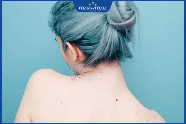 Nốt ruồi sau lưng nữ giới