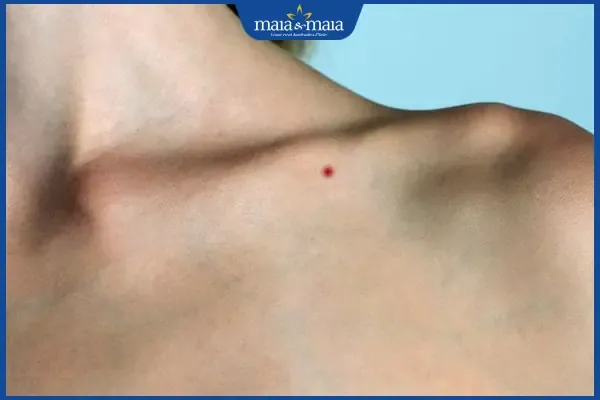 Nốt ruồi son ở xương đòn mang ý nghĩa tài lộc, sung túc